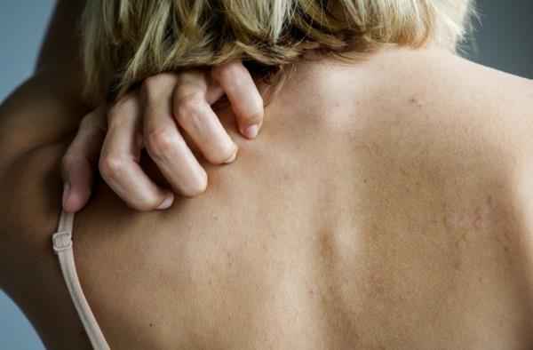 מה עוזר נגד גירוד עור עור מגרד בחזרה