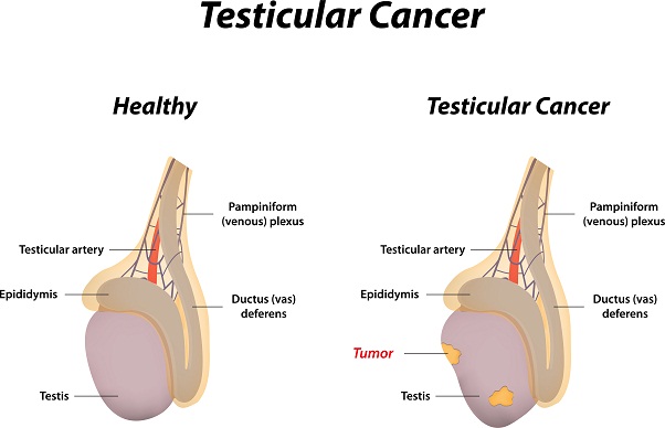 Síntomas del cáncer de testículo
