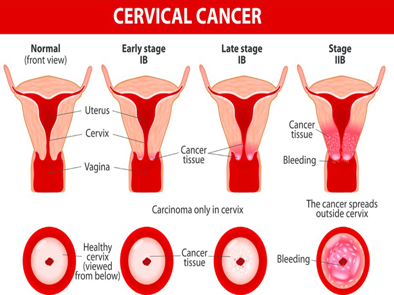 Sintomi e cause del cancro cervicale