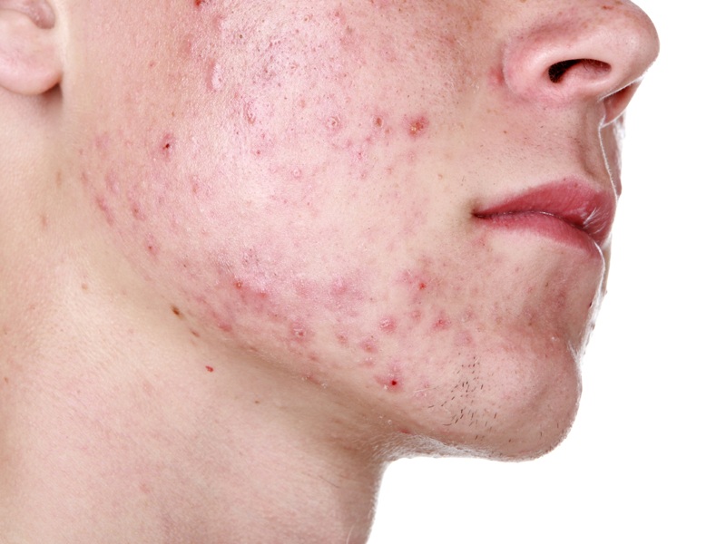 Come sbarazzarsi dell'acne ormonale?