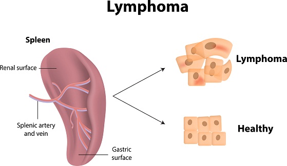 causas-y-síntomas-del-linfoma