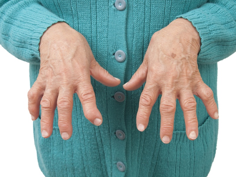 Síntomas y causas de la artritis reumatoide