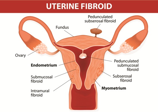 fibromas