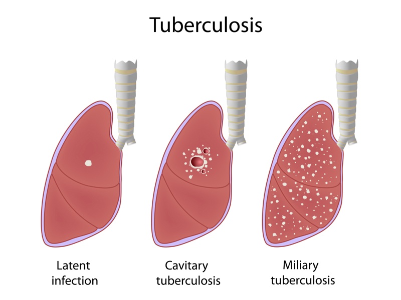 Síntomas y causas de la tuberculosis (tb)