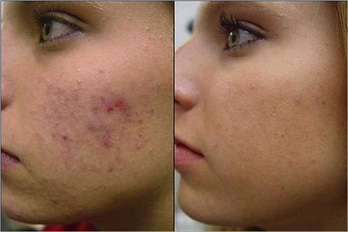 Incontro con il dermatologo per l'acne cistica